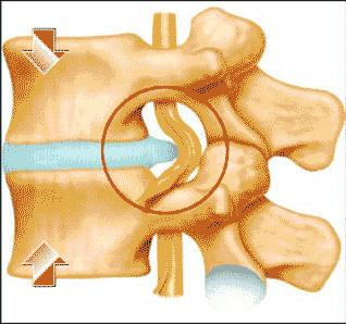 腰椎间盘突出正确锻炼方法,腰椎间盘突出吃什么药有效