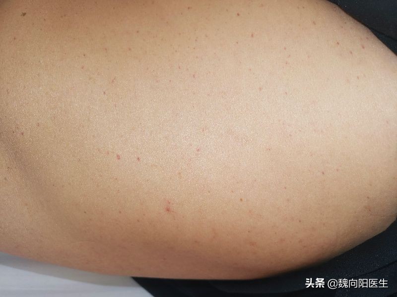 阿司匹林起皮疹还能继续服用么,阿司匹林肠溶片过量会不会起皮疹