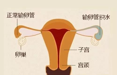 输卵管积水微创手术怀孕几率多少,输卵管伞端粘连积水能自然怀孕吗