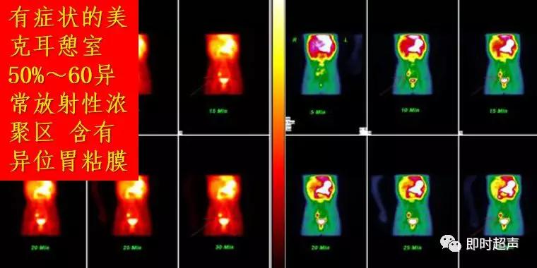 小儿消化道急症超声