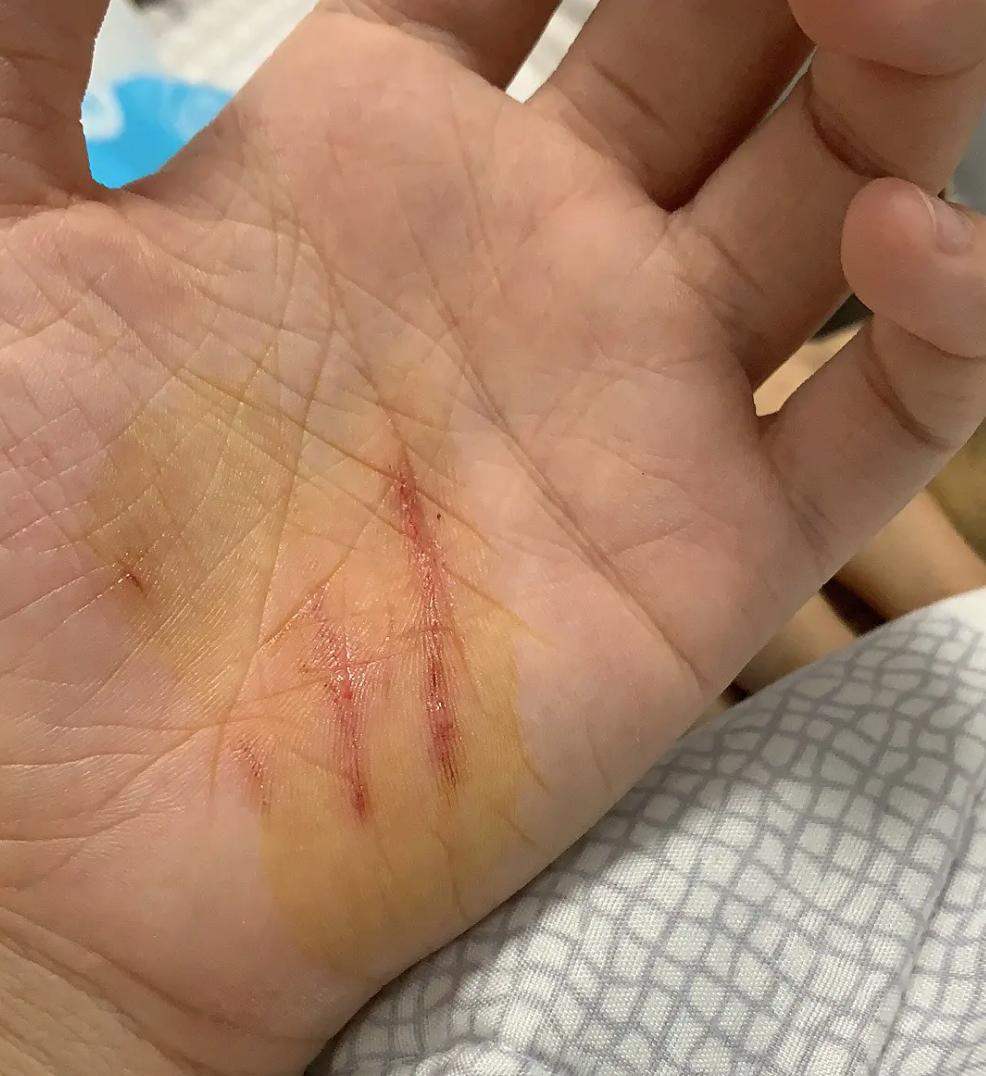 猫咪绝育前应激还能绝育吗,公猫咪绝育后伤口流血红肿怎么办