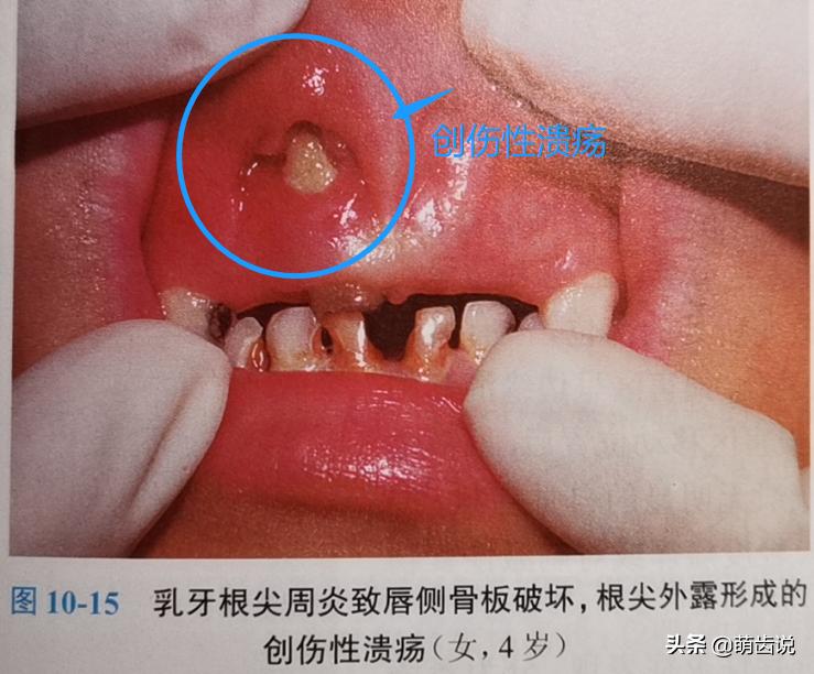 宝宝喊牙疼上嘴唇肿了是什么原因,宝宝牙疼为什么晚上疼得厉害