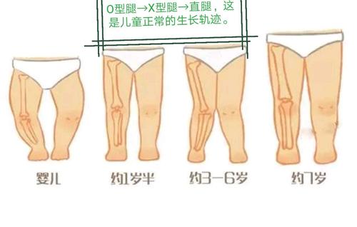 孩子腿有点o型腿该怎么办,七岁孩子xo型腿怎么矫正