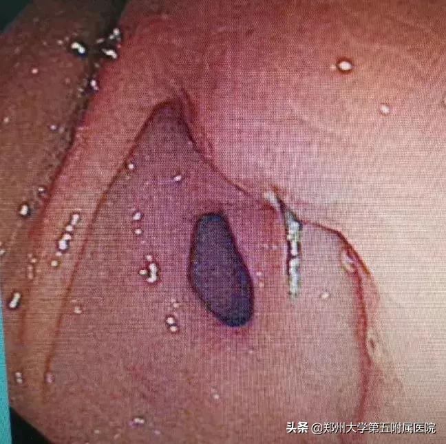 初中生胃疼怎么办,14岁胃疼吐血怎么回事