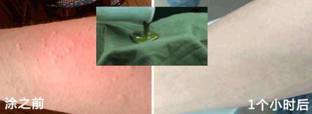 湿疹性皮炎最简单的自愈方法,全身都痒皮炎湿疹最好的治疗方法