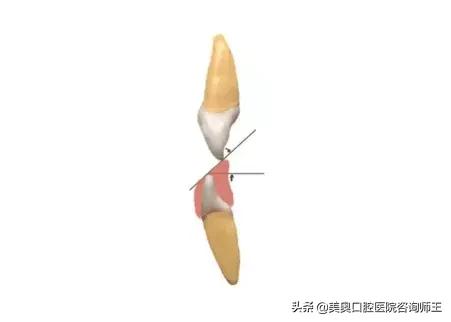 牙齿矫正地包天多久能看到效果,地包天越早矫正越好吗