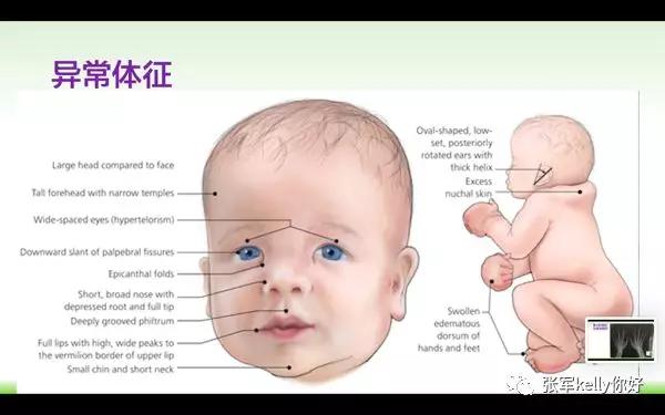 Turner综合征的指南学习