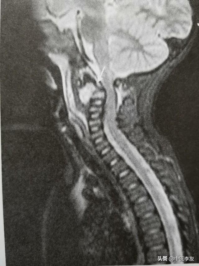 腰椎骨结核治愈后出现腰疼,脊柱结核腰痛怎么治
