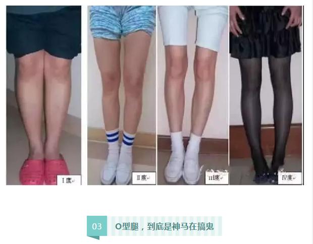 站立时双腿并拢可以矫正o型腿吗,怎么走路可以矫正o型腿