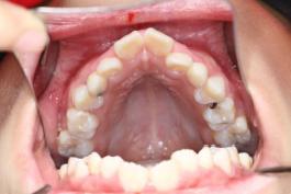 8岁的孩子能做牙齿矫正吗,7岁孩子矫正牙齿早吗