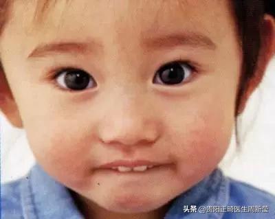 12岁前必须解决的错颌畸形,孩子十二岁牙畸形怎么办
