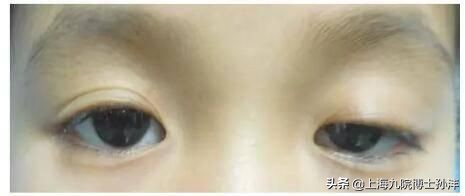 双眼皮为什么会出现眼袋,双眼皮松弛下垂哪种手术比较好