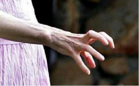 腱鞘炎已经不是妈妈们的专利，它正把魔爪伸向当代年轻人···