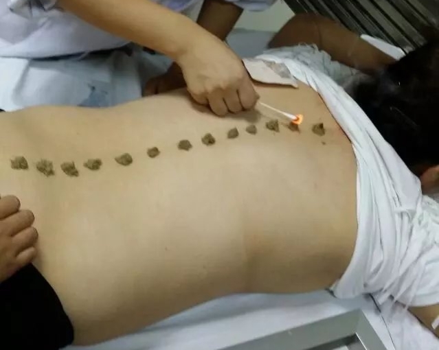 周楣声灸法理论,周楣声谈吹灸