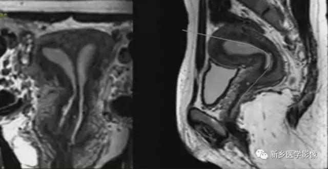 常见的几种子宫畸形诊断标准,先天性子宫畸形是什么原因造成的
