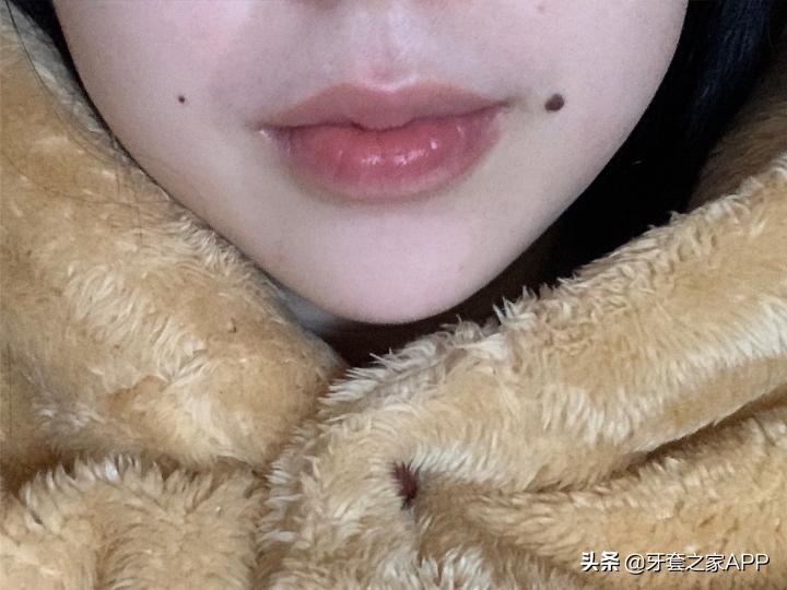 不靠整容怎么改变下巴后缩？看这里