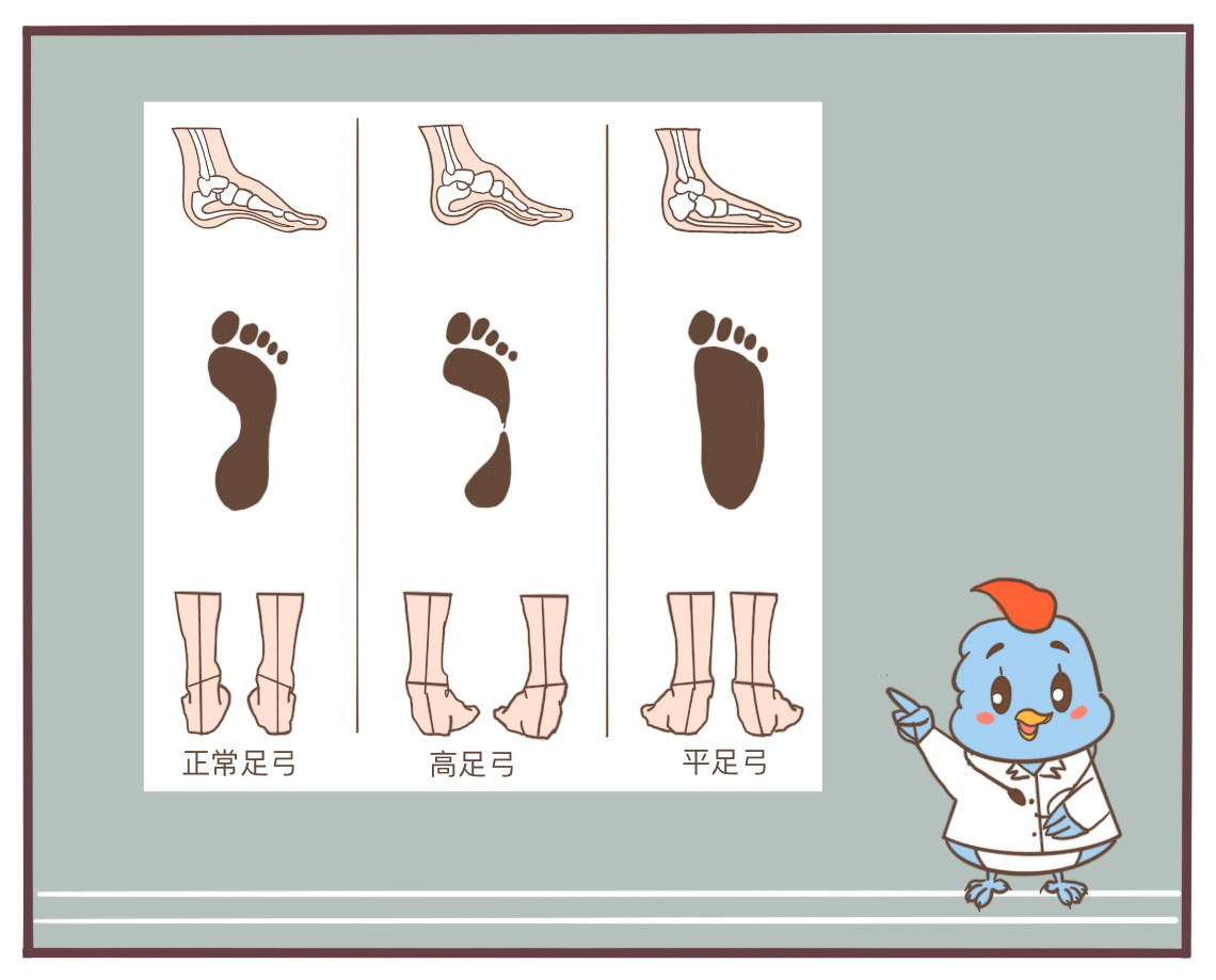 扁平足的矫正方法动画片,扁平足的危害漫画