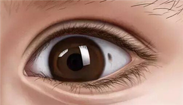 孩子眼白上的黑斑是什么,孩子眼白有很多色斑是什么原因