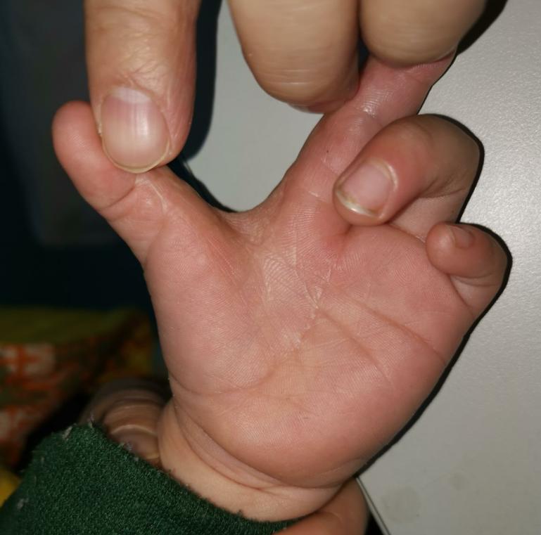 并指畸形免植皮案例,并指畸形