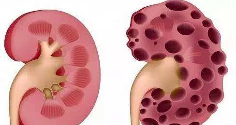 多肾囊肿怎么治疗,肾囊肿会引起高血压吗