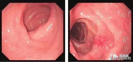 胃内黄斑瘤和萎缩性胃炎可怕吗,萎缩性胃炎不可怕视频