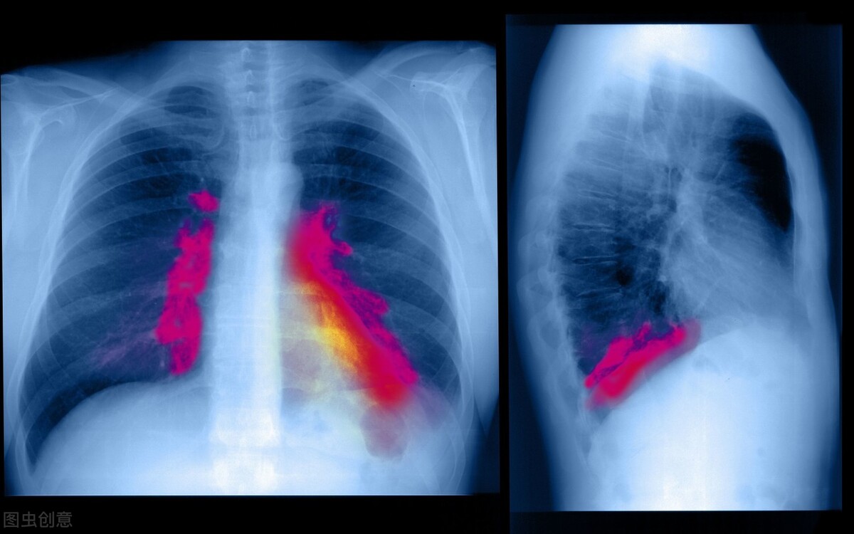 肺结节属不属于重疾,肺结节是不是属于肿瘤