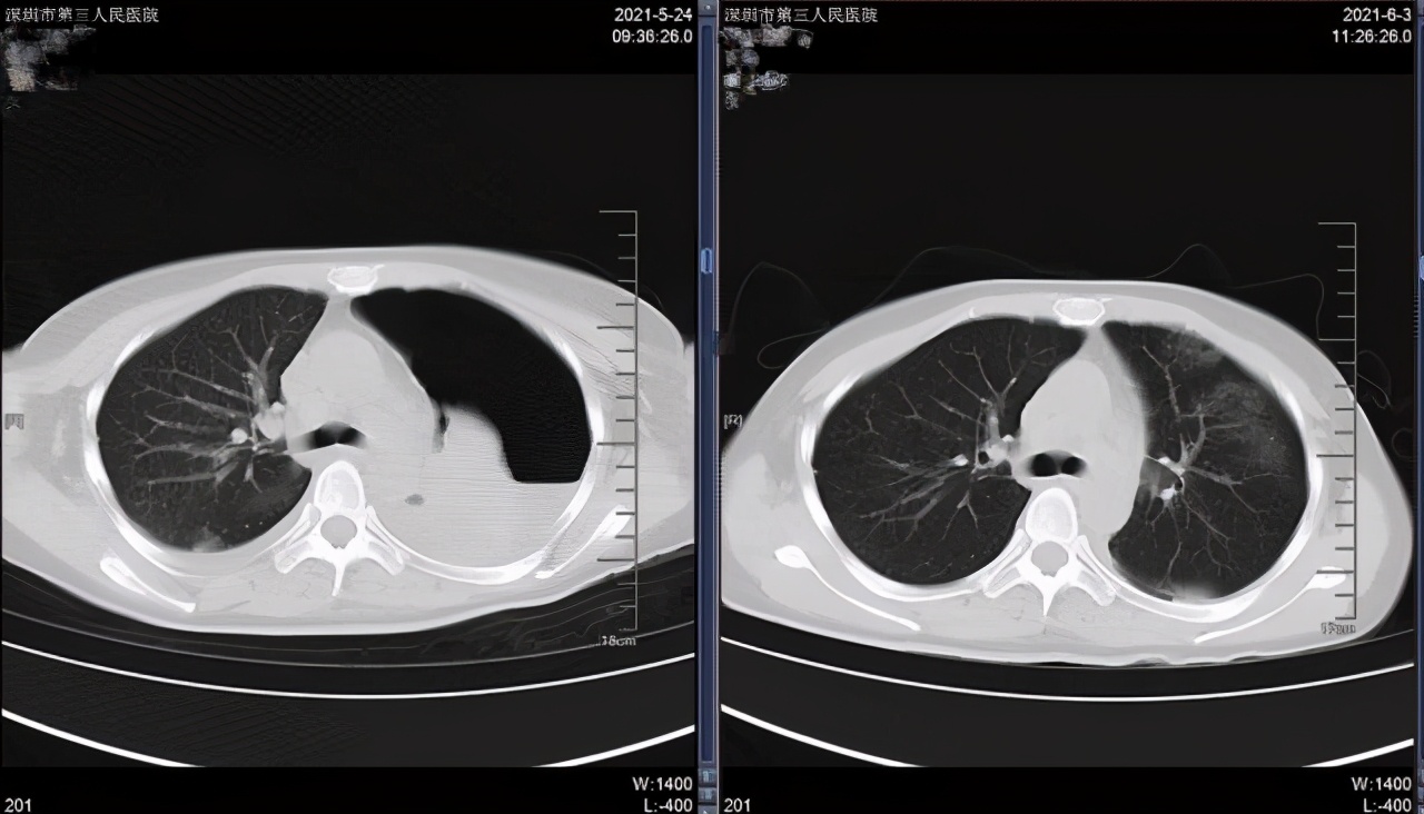 深圳首例！深圳市三院成功救治一名跳跃型脊柱结核患者