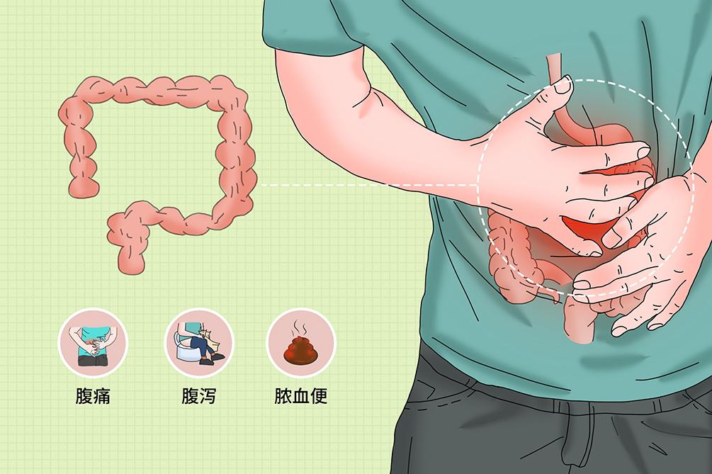 溃疡性结肠炎中医还是西医治疗好,我国治疗溃疡性结肠炎的中医专家