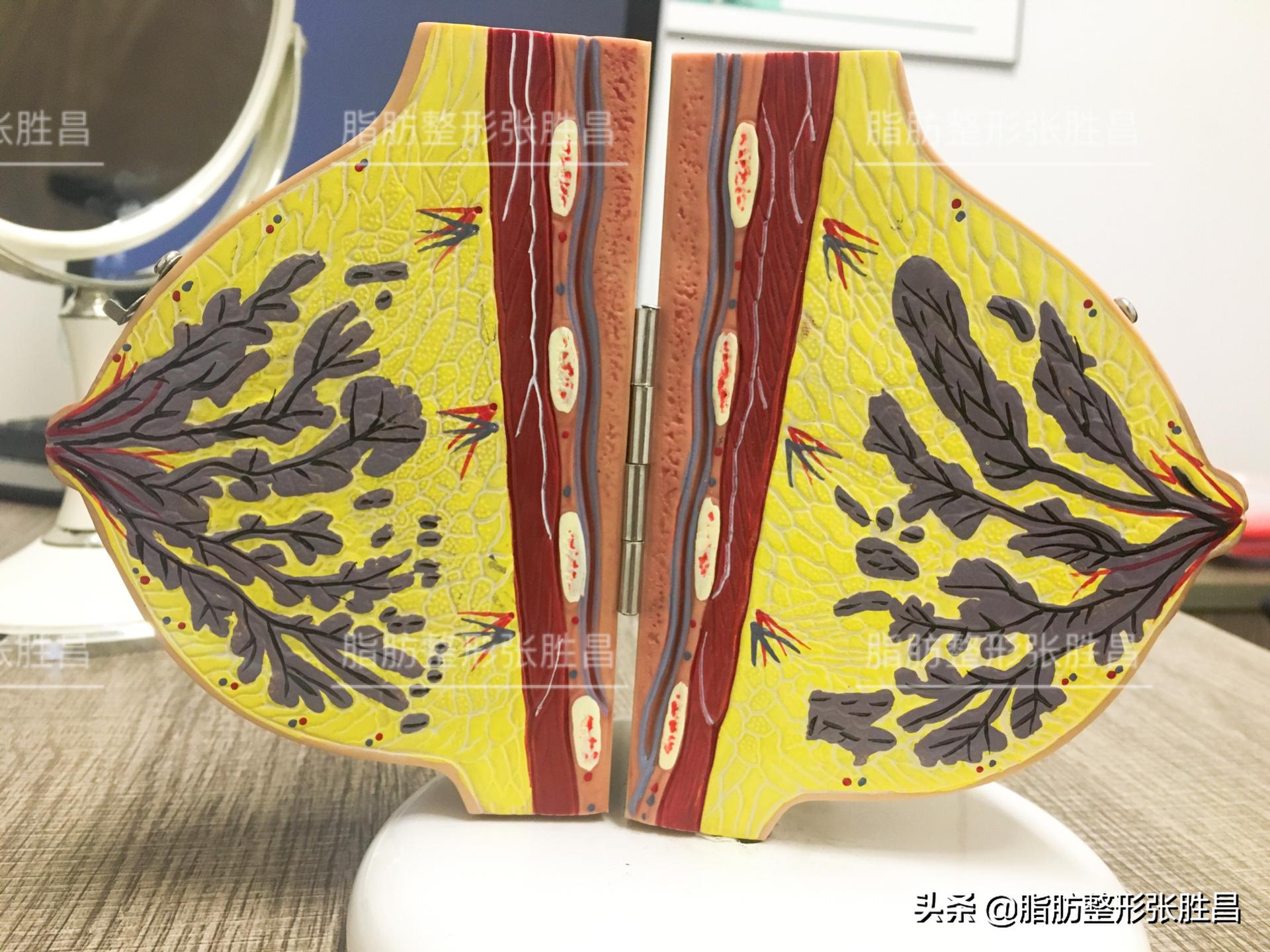 自体脂肪隆胸后注意事项,做完自体脂肪隆胸注意事项