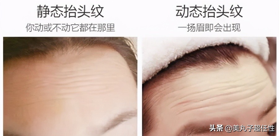 一招解决抬头纹的方法,抬头纹真正解决办法