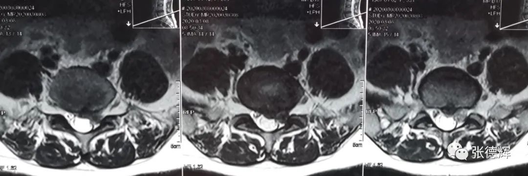 腰椎间盘突出症脊柱内镜微创手术后路镜下视频演示