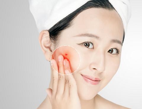 皇家雨燕教你痘痘肌の正确保养方式