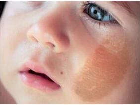 如何区分脸上色斑类型图片,如何辨别面部的各种斑