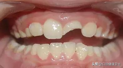 幼儿门牙摔断了怎么办,摔崩的门牙怎么补救