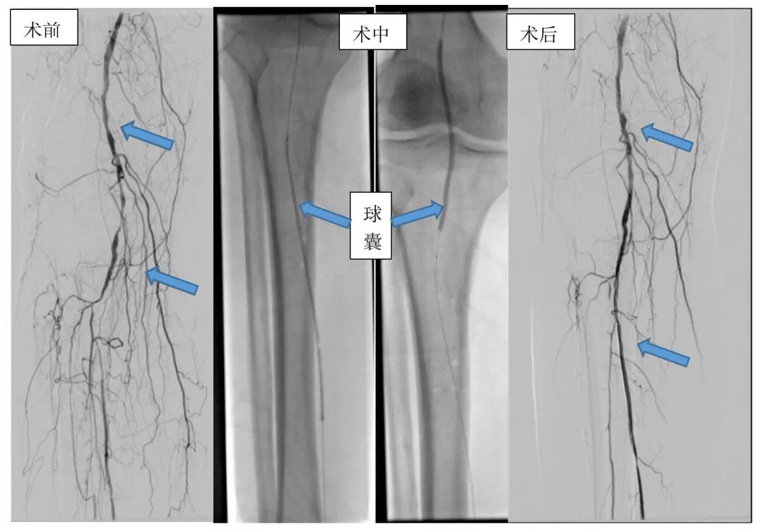 老烂腿清创手术要多少钱,老烂腿清创换药步骤