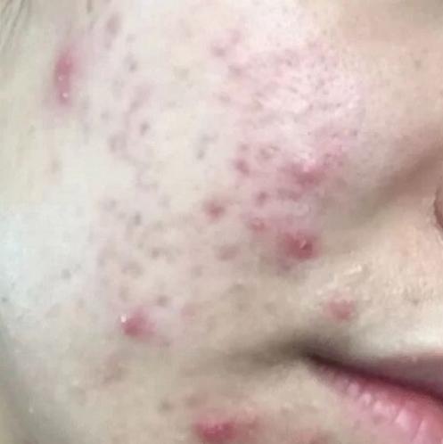 混合油皮男士洗面奶控油祛痘,男士控油淡化痘印洗面奶推荐