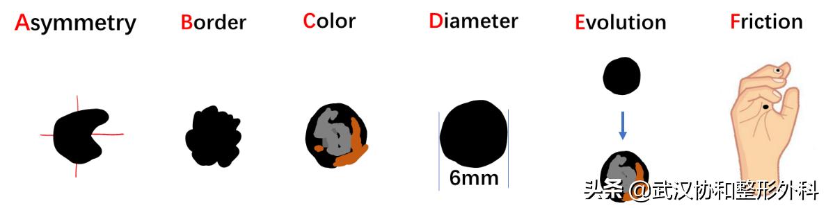 长了很多黑痣是什么原因,不规则的黑痣一定会癌变么
