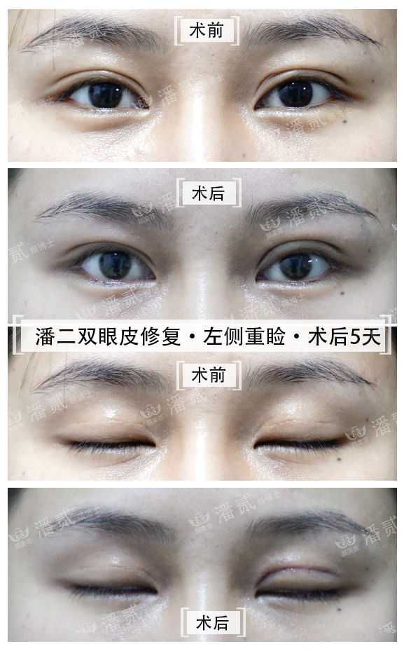 韩式精雕微创双眼皮,韩式微创双眼皮恢复过程真实记录