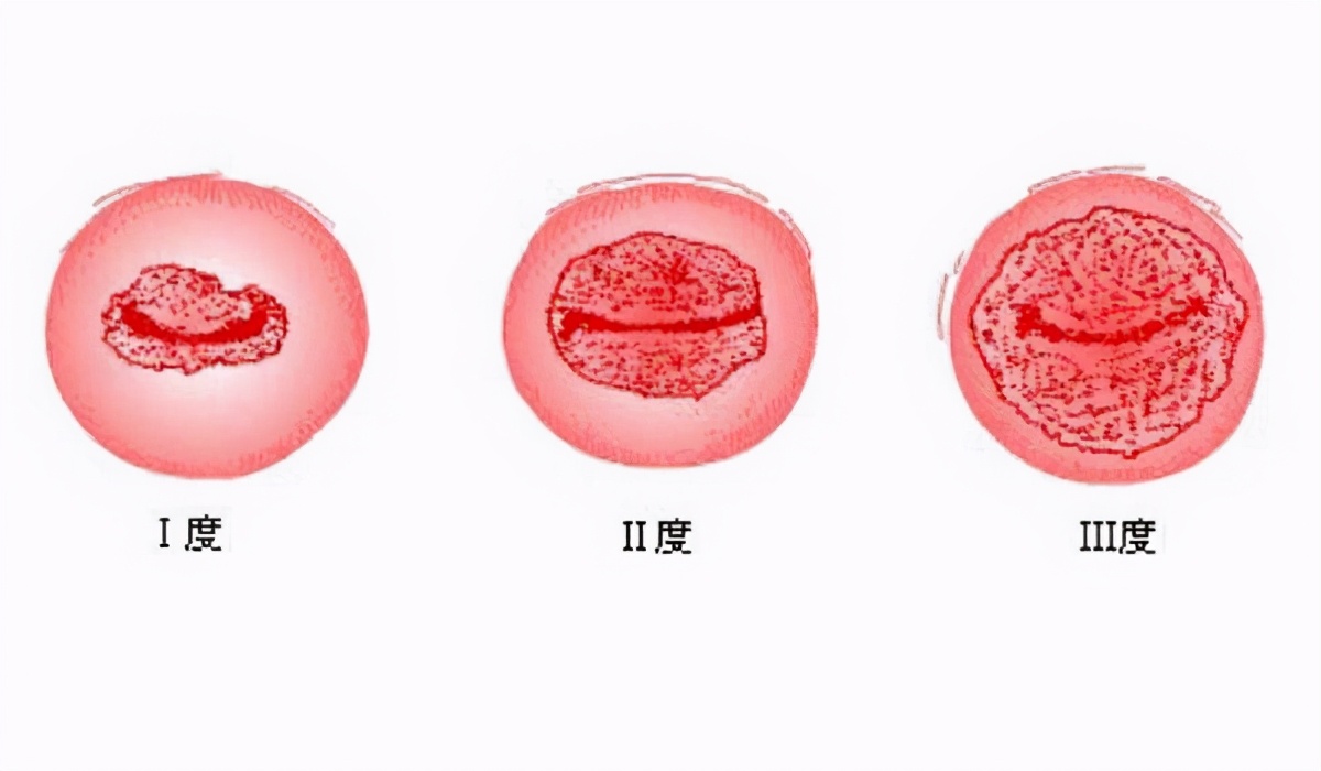 宫颈糜烂合并hpv感染严重吗,hpv感染加糜烂会有什么症状