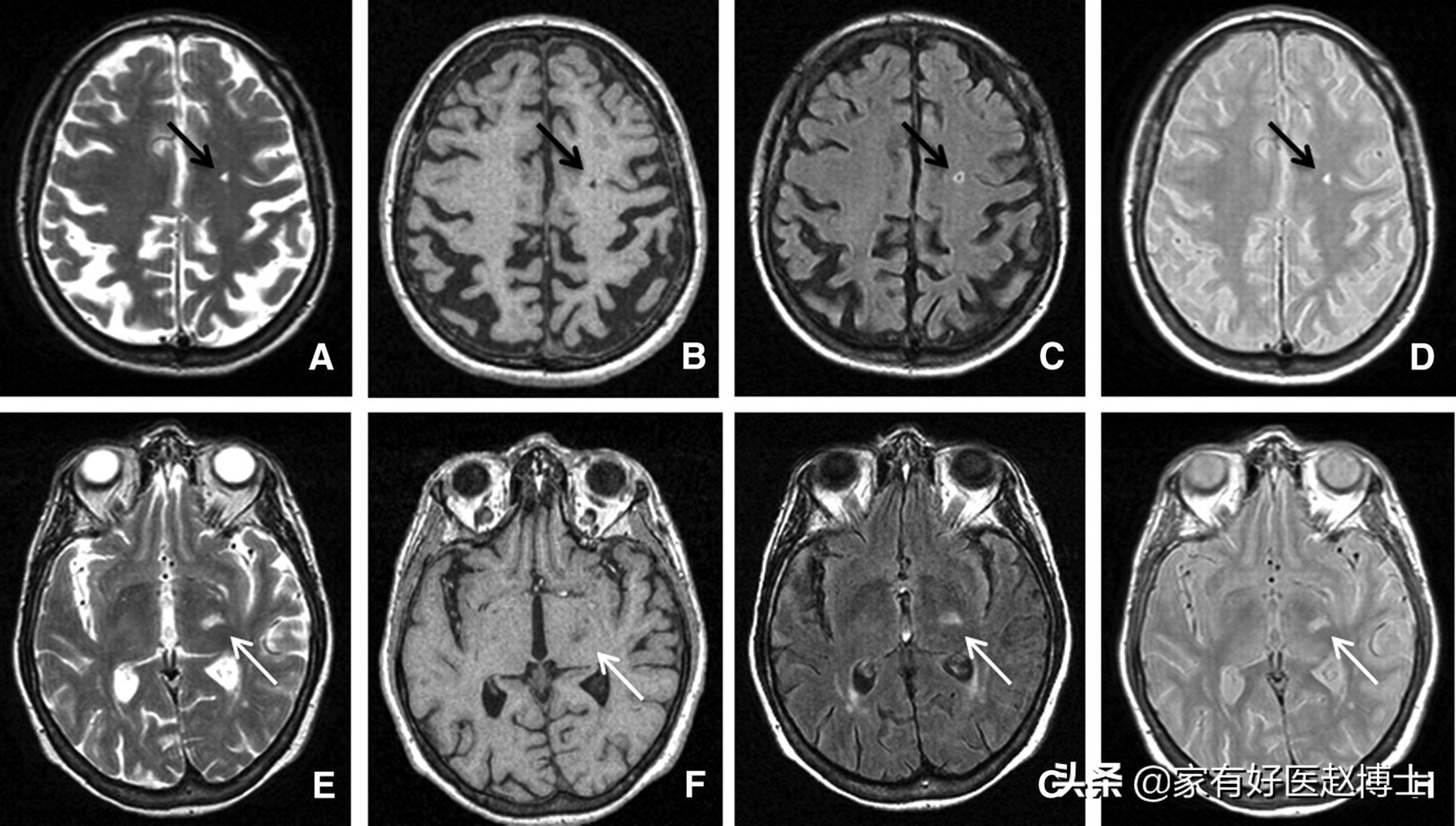 减缓血管老化做好以下几点,老人血管老化可以吃安宫牛黄丸吗