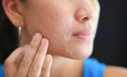 脸上过敏发红肿发痒怎么办最有效,脸上过敏发红肿怎样才能消除