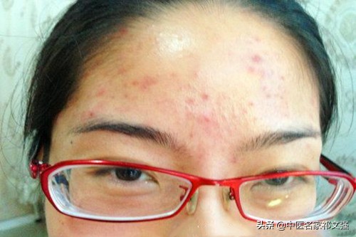 长疮的中医辨证论治,疮疡后期中医治疗法则