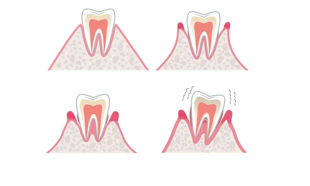 牙齿痛完不痛后需要做根管治疗吗,牙齿痛了过后不疼了可以去补吗