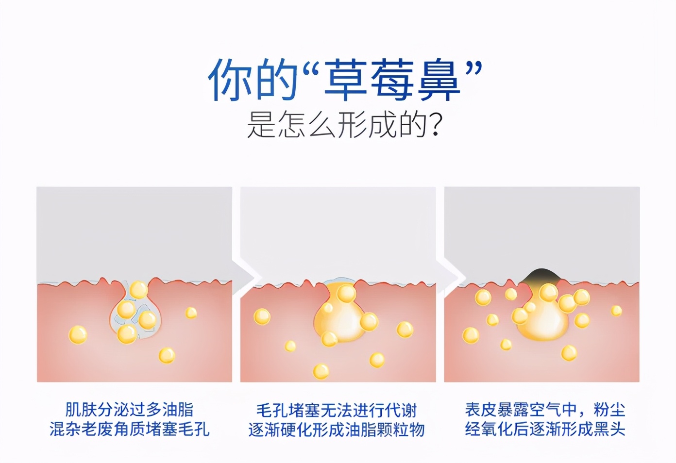 祛黑头的正确步骤,鼻子黑头怎么去除最有效医学