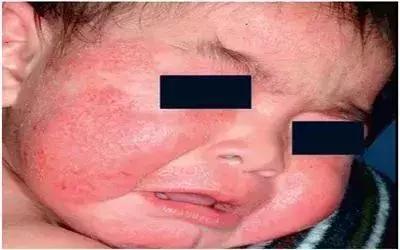 怎么区别麻疹和风疹,麻疹识别图