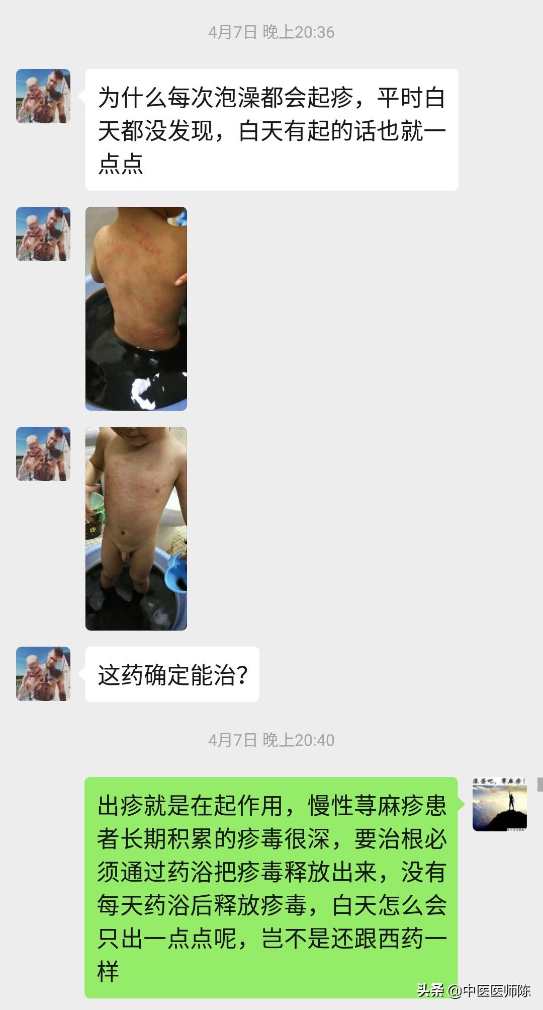 2岁半小儿*麻疹荨**久治不愈中途又发生医患误会，结局不可思议
