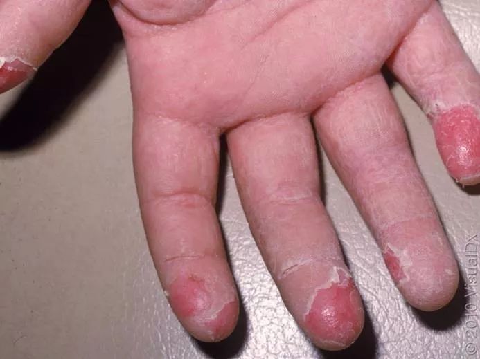 发热出红疹子可以吃过敏药吗,发热皮疹会反复么