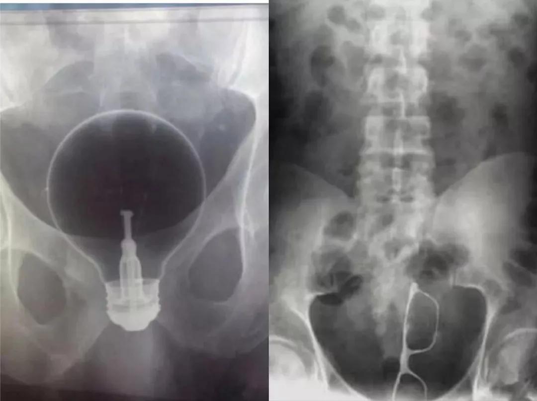 男子体内塞电线,男子嘴里塞了灯泡