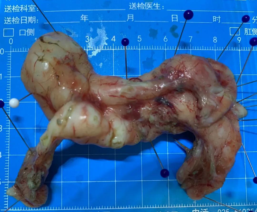 食管粘膜下肿物内镜切除,内镜切除食管巨大肿物