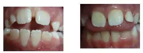 4岁舌系带过短要不要剪,什么是舌系带短图片